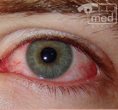 хламидиоз глаз лечение