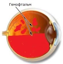 гемофтальм глаза лечение