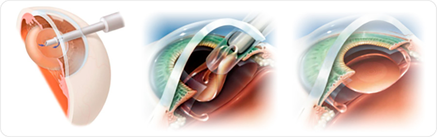 Лечение катаракты глаза - операция