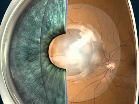 Вторичная катаракта: лечение