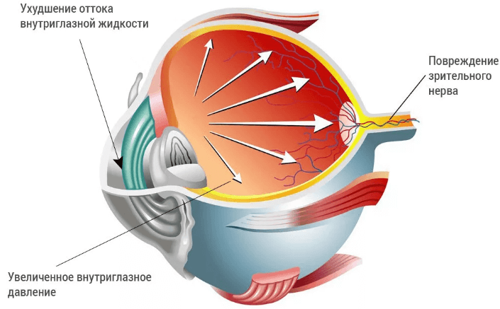 Схематичное изображение глаукомы