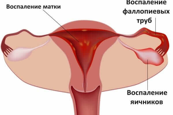 Схема воспаления яичников и лечения в клинике Медведева