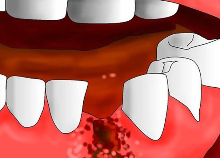 Удалить зуб последствие. Постэкстракционный альвеолит. Альвеолит зубной лунки. Альвеолит воспаление лунки.