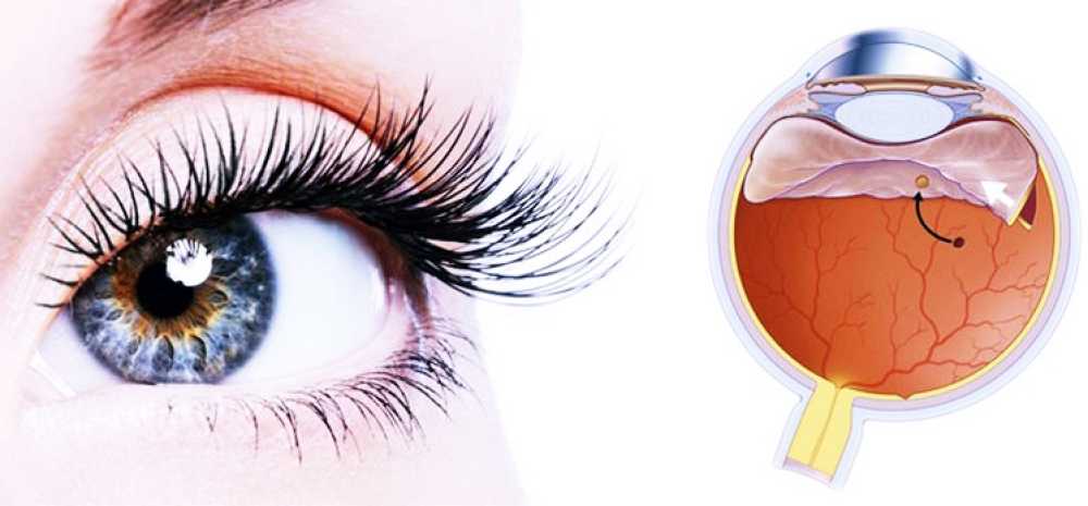 Ангиопатия сетчатки глаз лечение в клинике федорова