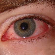 Убрать красные сосуды глаз хирургически