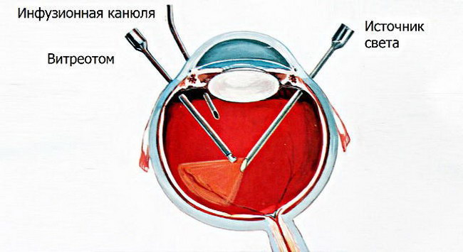 Стекловидное тело операция. Отслойка сетчатки витрэктомия. Витрэктомия сетчатки глаза. Субтотальная витрэктомия.