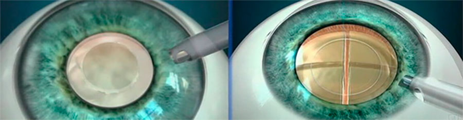 Лечение катаракты глаза - операция