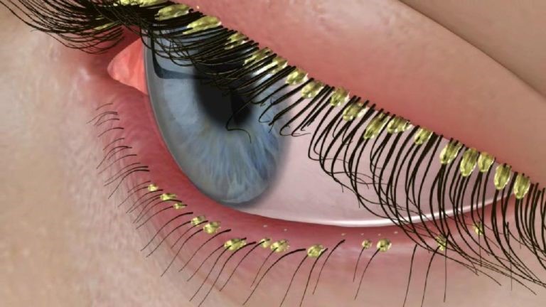 Лечение демодекоза глаз в москве