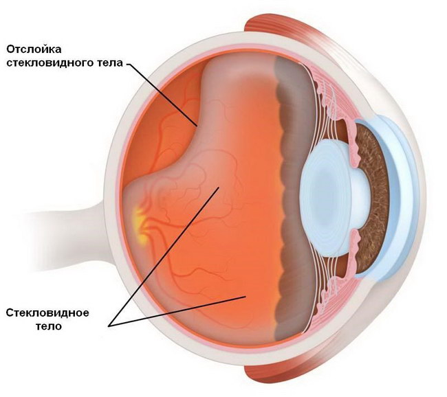 Деструкция стекловидного тела глаза - причины и лечение