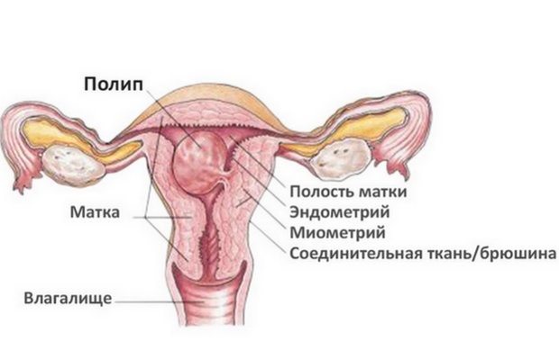 Лечение полипов эндометрия: записаться на прием в клинику МЕДСИ в Перми