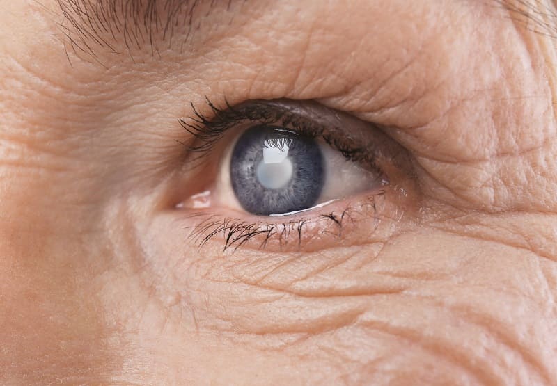 Лечение возрастной катаракты