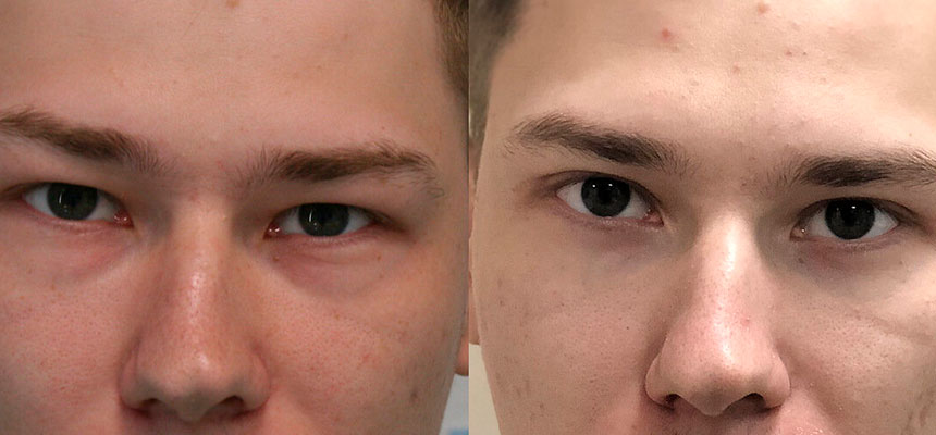 Блефаропластика у мужчин фото до и после