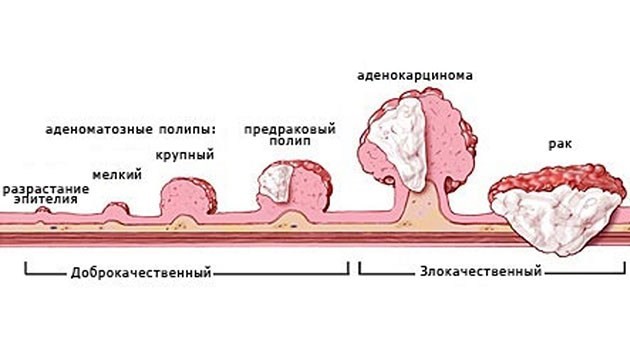 Полип эндометрия